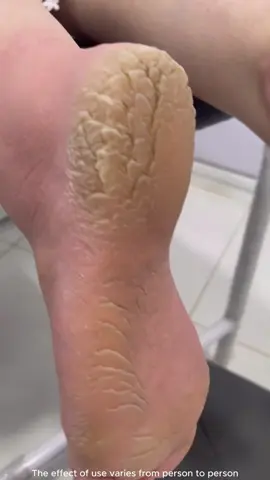 #footpeel #footpeeling #footmask #footcareroutine #tiktokshop #fyp #fypシ #foryourpage #lanbena 