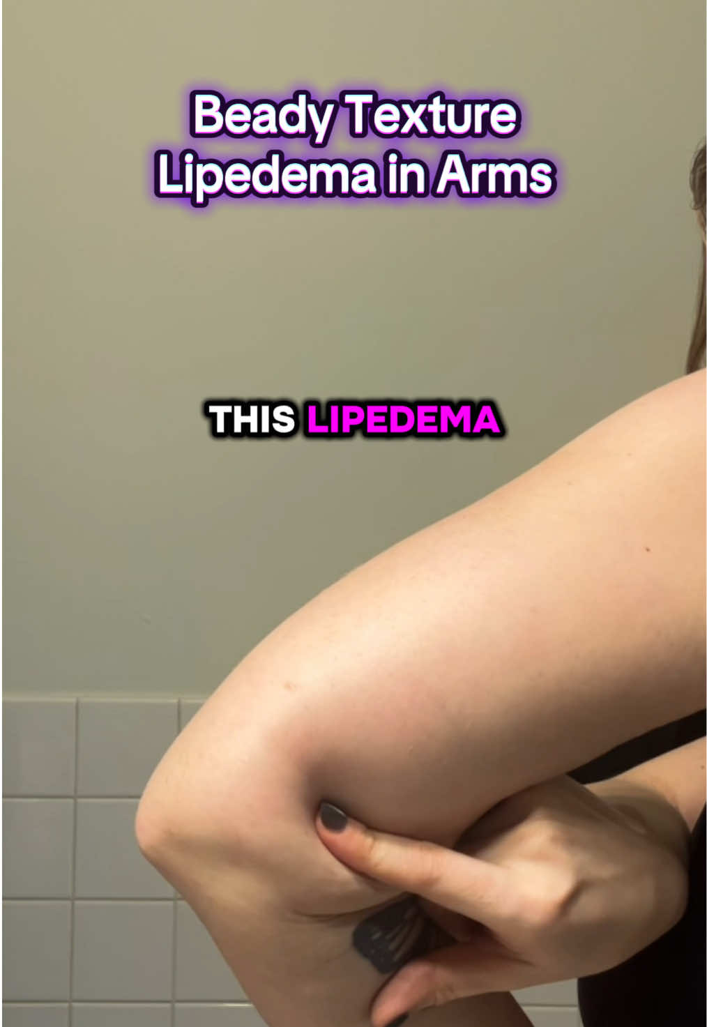 Lipedema in the Arms and how to identify it. #creatorsearchinsights #lipedema #lipedemaarms #armfat #arms #lipedemafighter 