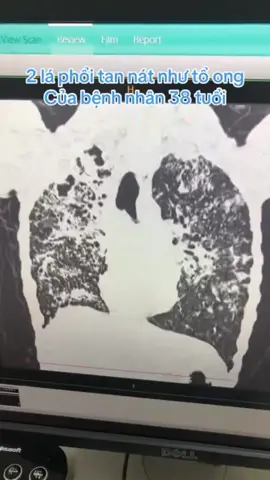 #phoi #vienphoi #henphequan #ungthuphoi #baithuocdangian #thaomocmiennam1 