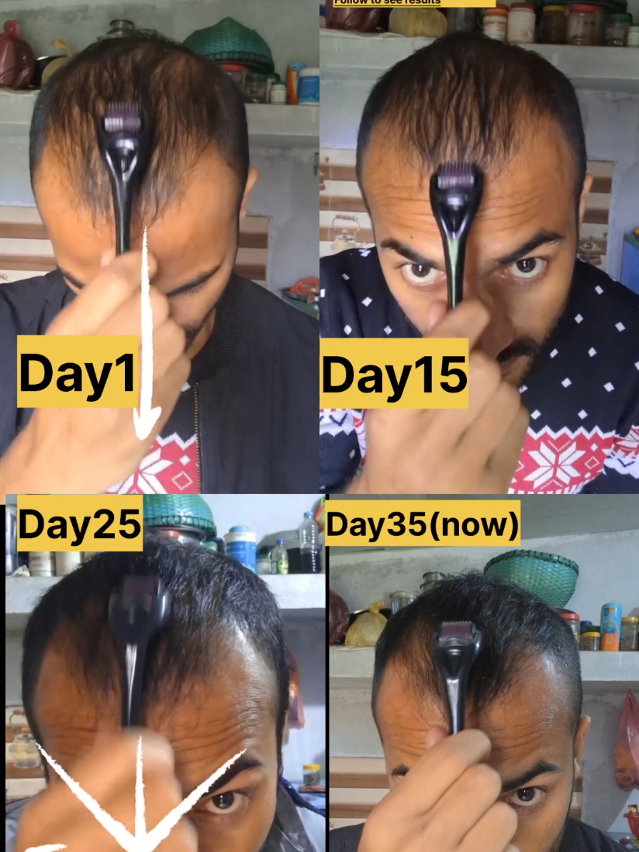 Day35 dermaroller result🔥 #dermaroller #jamalgota #hairgrowth #hairfall #hairgrowthjourney 