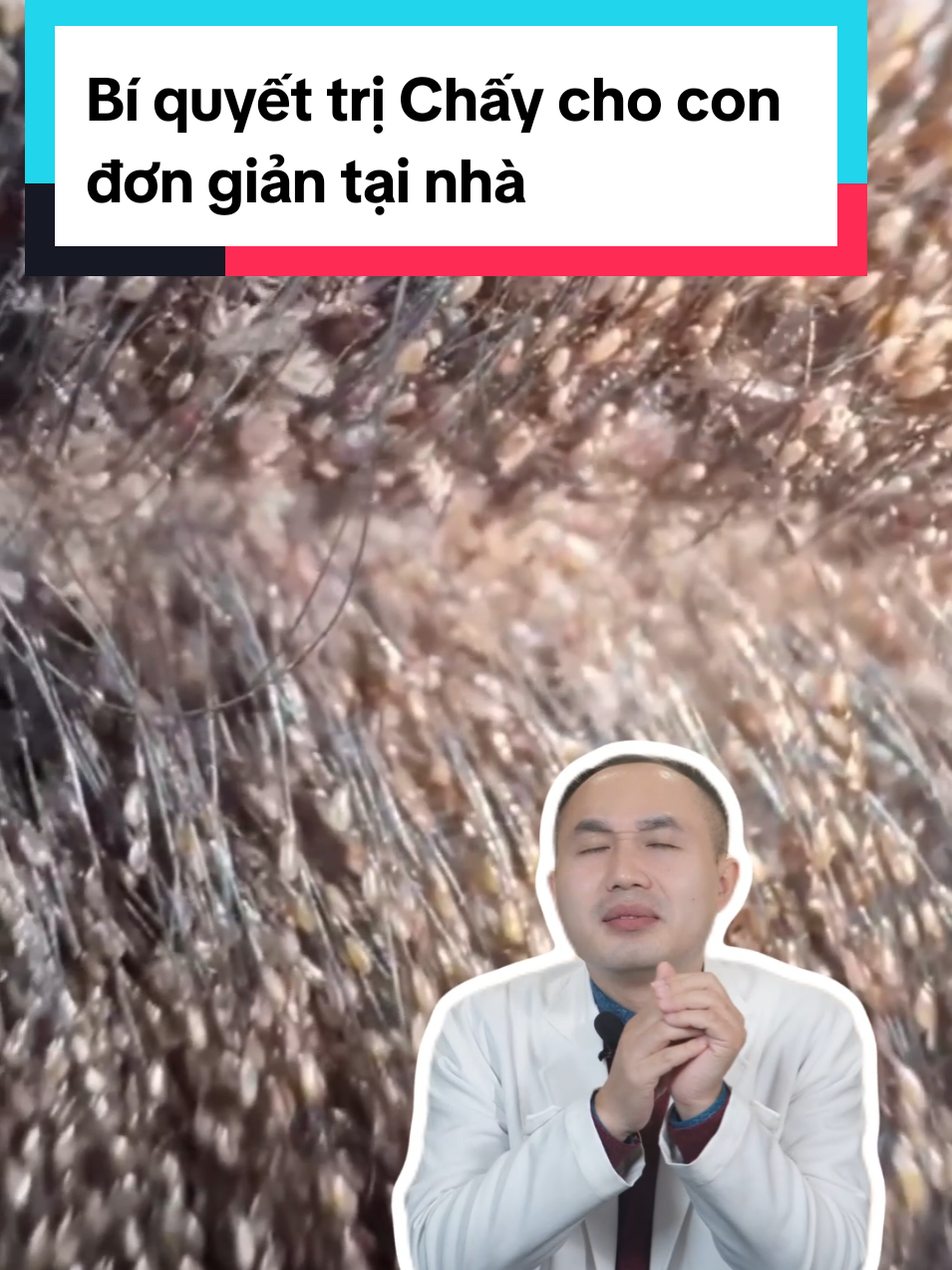 Bí quyết trị Chấy cho con đơn giản tại nhà vô cùng hiệu quả #education #LearnOnTikTok #duocsi #duocsichat #songkhoe247 #mevabe #treem #congai #embe #nuoicon #chamcon #chay 