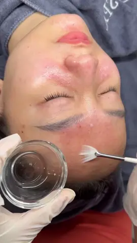 𝐓.𝐂. 𝐀𝐆𝐄 𝐈𝐧𝐧𝐨-𝐄𝐱𝐟𝐨 peel sẹo rỗ, sẹo đáy nhọn, lỗ chân lông to  💫 𝐏𝐄𝐄𝐋 𝐓𝐂𝐀 là phương pháp Peel da sử dụng hoạt chất Tricloacetic Acid (TCA) để điều trị lỗ chân lông to , làm sáng da  𝐏𝐞𝐞𝐥 𝐓𝐜𝐚 𝐚𝐠𝐞 𝐢𝐧𝐧𝐨, cải thiện lỗ chân lông to. Peel  hỗ trợ điều trị sẹo đáy nhọn , sẹo rỗ ( theo mức độ )      Thành phần chính👇 ▪️ Trichloroacetic acid (TCA): là một loại hoạt chất có khả năng điều trị mụn , sẹo rỗ, trẻ hóa da.  ▪️ TCA có nồng độ 15%: Xâm nhập nhanh chóng đến lớp tế bào hạt ở lớp thượng bì làm bong lớp sừng thô cứng ▪️ Alcohol denat : có chức năng như một chất làm se khít a lỗ chân lông nhanh chóng. Hỗ trợ kháng khuẩn và trị mụn.  ▪️ Salicylic axit : có chức năng tẩy tế bào chết sâu trong lỗ chân lông, loại bỏ nhanh các vi khuẩn và giảm các vấn đề về mụn ( mụn viêm ,mụn ẩn )