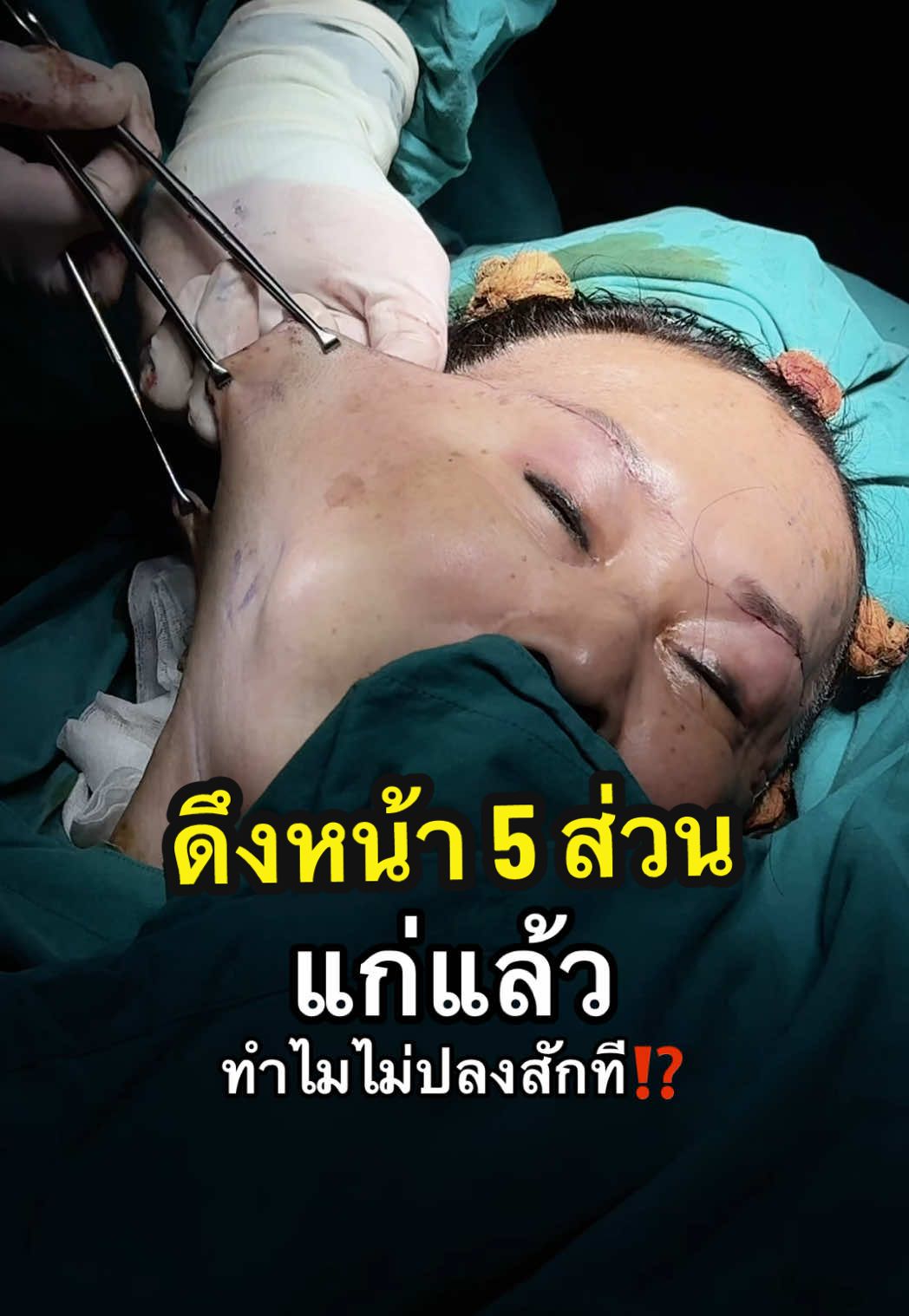จะอายุเท่าไหร่ก็ไม่มีใครอยากแก่ #ดึงหน้าย้อนวัย ลดอายุไป 10 ปี‼️ #ดึงหน้า #facelift #подтяжкалица #ลดอายุ #ดึงหน้าลดอายุ #ป้าวัย70ยังสวย #คุณยาย #อายุ70 #หน้าเหี่ยว #หน้าแก่ #ยกคิ้ว #ตาสองชั้น #หน้าเด็ก #ย้อนวัย #รีวิวดึงหน้า #รีวิวศัลยกรรม #ศัลยกรรม #เลอนิสต้าคลินิก #lenistaclinic