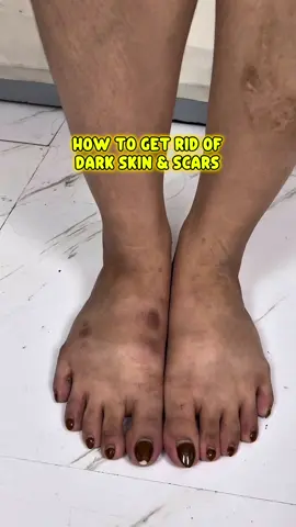 Skin imperfections? Shawill Sakura Got U! #whiteninglotion  #collagen  #instantwhite  #clearskin 