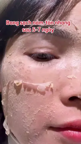 7-10 ngày bong sạch nám, tàn nhang #làmđẹp #xuhuongtiktok #trịtànnhangtạinhà #táitạo #pell #thâm #pellnám #bong #xuhướng #yody #yodyphươnganh #táitạoda #tritannhang #nam 