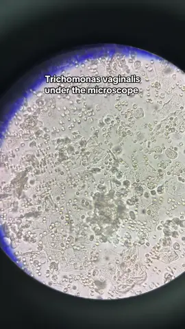 High Vaginal Swab (HVS) Microscopy: Numerous Trichomonas vaginalis Trophozoites, Pus Cells, RBCs & Epithelial Cells Detected. Trichomoniasis Under the Microscope! 🦠🔬 👉 Symptoms: Yellow-green frothy discharge, foul odor, itching, burning, and discomfort during urination or intercourse. 👉 Causes: Trichomonas vaginalis, a parasitic protozoan. 👉 Transmission: Primarily through unprotected sexual contact. 👉 Treatment: Metronidazole or Tinidazole – both partners should be treated to prevent reinfection! Stay safe, get tested! ✅ #Trichomoniasis  #HVS  #Microscope  #Parasitology  #medicallaboratory  #SexualHealth  #gettested  #microbiology 
