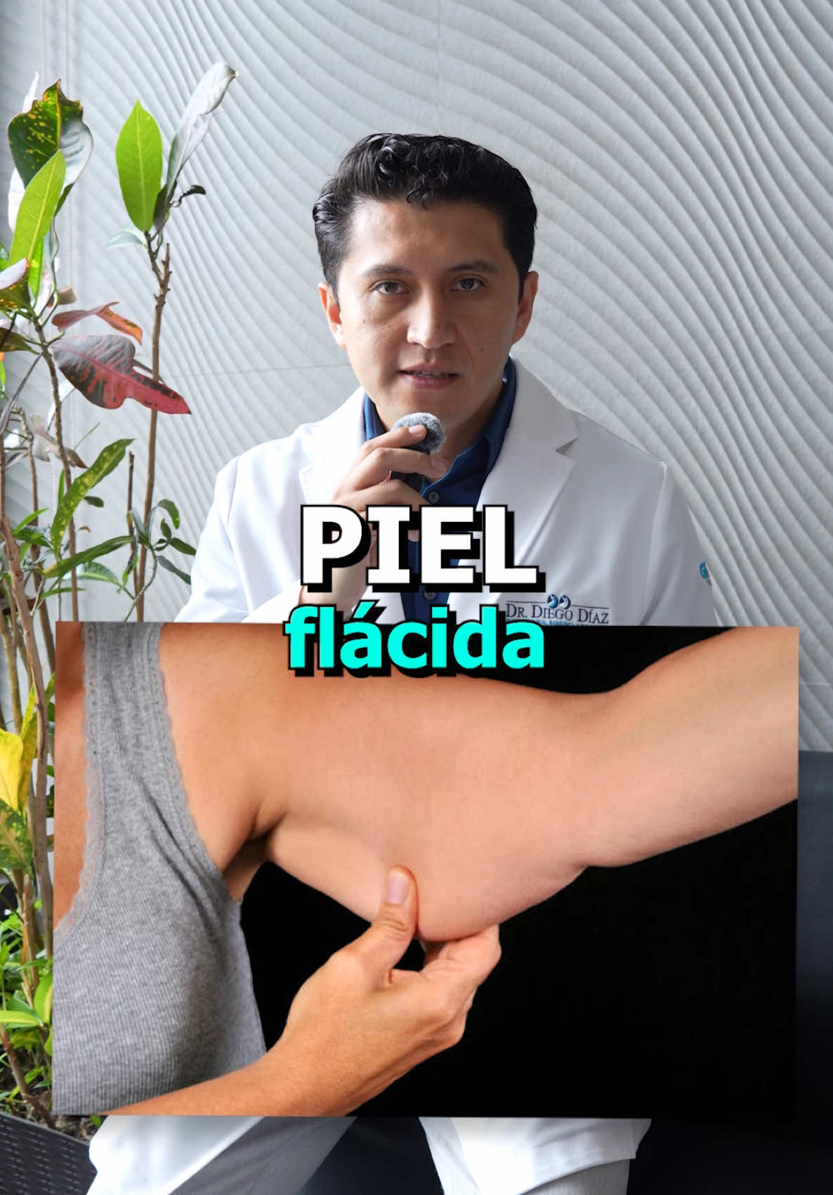 Flacidez después de la cirugía bariátrica 🏋️‍♀️💪 Tras un bypass gástrico o manga gástrica, la pérdida de peso puede causar flacidez en la piel. Combate esto con proteínas, hidratación y ejercicio. Para casos severos, existen tratamientos estéticos. ¡Tu transformación no termina con la cirugía! #CirugíaBariátrica #BypassGástrico #MangaGástrica #PérdidaDePeso #Flacidez #TransformaciónCorporal #SaludYBienestar #Nutrición #Ejercicio #VidaSaludable @Dr. Diego Díaz cirujano @Dr. Sebastián Arteaga 