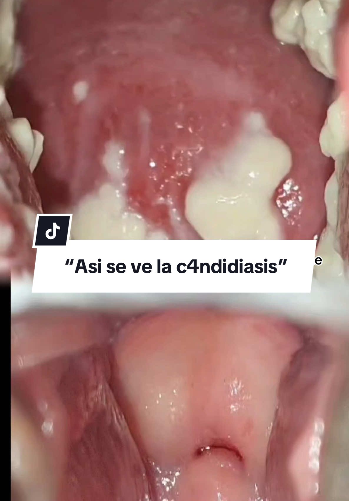 Las infecciones v4ginales son más comunes de lo que piensas y pueden ser recurrentes. Algunos síntomas incluyen picazón, ardor al orinar, flujo anormal o mal olor. Si experimentas alguno de estos signos o la prima de una amiga, es importante no ignorarlos y recibir atención médica.  En @Médica RISO, te ayudamos a detectar la causa y brindarte el tratamiento adecuado. ¡Agenda tu cita hoy mismo de infecciones! 💕👩‍⚕️  @GinecologiaMR  Cédula especialidad 9444305 COFEPRIS 213300202A0523 UNIVERSIDAD ANÁHUAC  #SaludFemenina #CuidadoÍntimo #MédicaRiso #candidiasis #candida #tratamiento #salud #hongo #mujer #mujeres #ardor #picazon #grumo #obstetra #parati #fyp #microbiotavaginal #microbiota #infeccion #saludintima #acidoborico #ovulo #antimicoticos #jabon #evaluacion #its  #video #travel #trendingvideo #foruyou #trendingvideo #infecciones #consultas #trends  #tiktoknews #tiktokviral #videoviral #DraGloriaRivero #gineco #ginecocdmx #ginecocancun #ginecologia #cancun #mexico #cdmx 