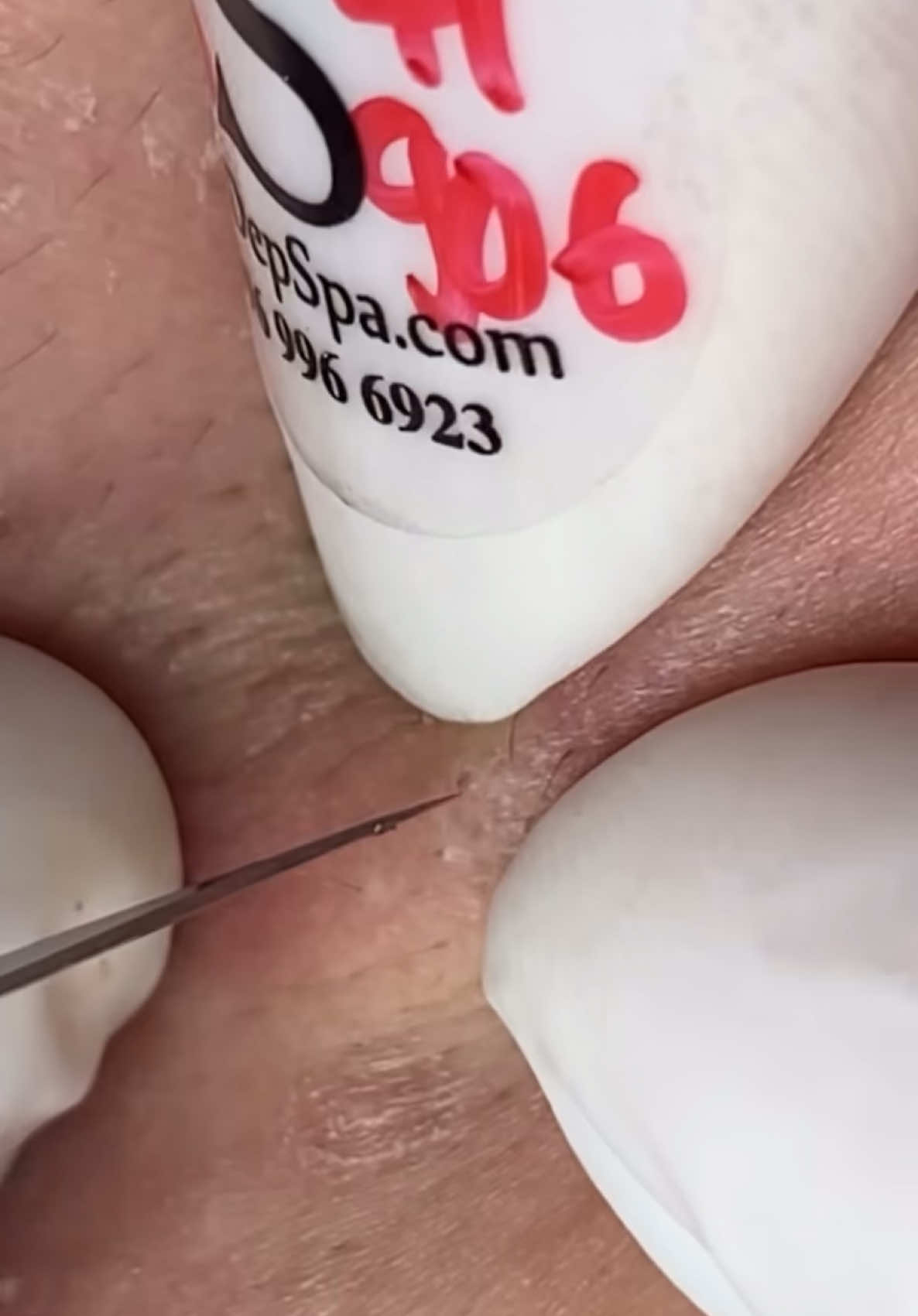 #pimples #pimplepop #blackhead #removal #pimpleremover 