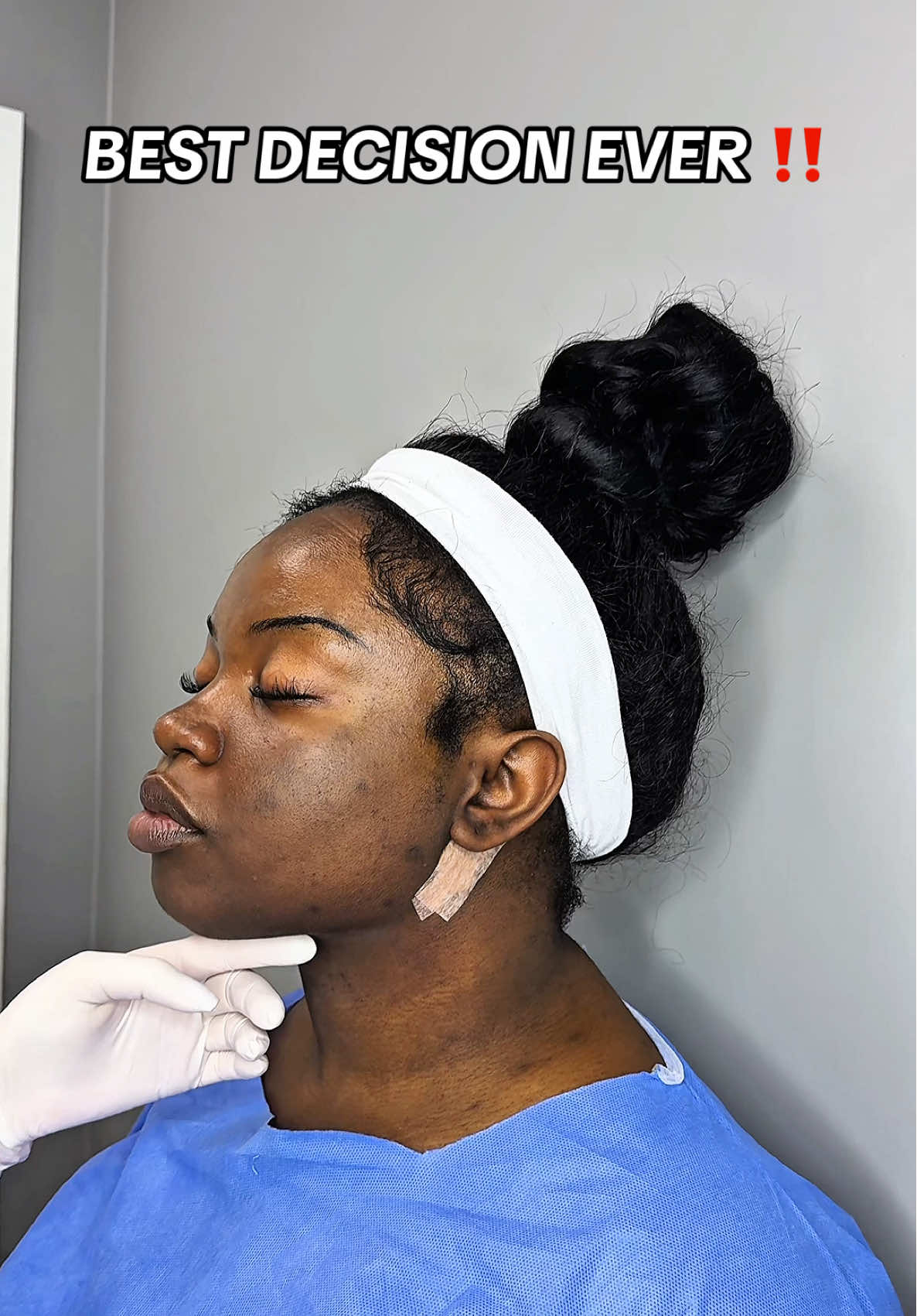 Double cin liposuction + tightening process before and after ‼️💗 ##chinlipo##chinliposuction##chinlipocheck##chinliporecovery##chinlipoupdate##doublechinlipo##doublechin##fyp##fypp##fypage##foryou##foryoupage##foryourpage##beauty##beforeandafter##viraltiktok##viralvideo##trendingvideo##trendingvideo##transformation##change