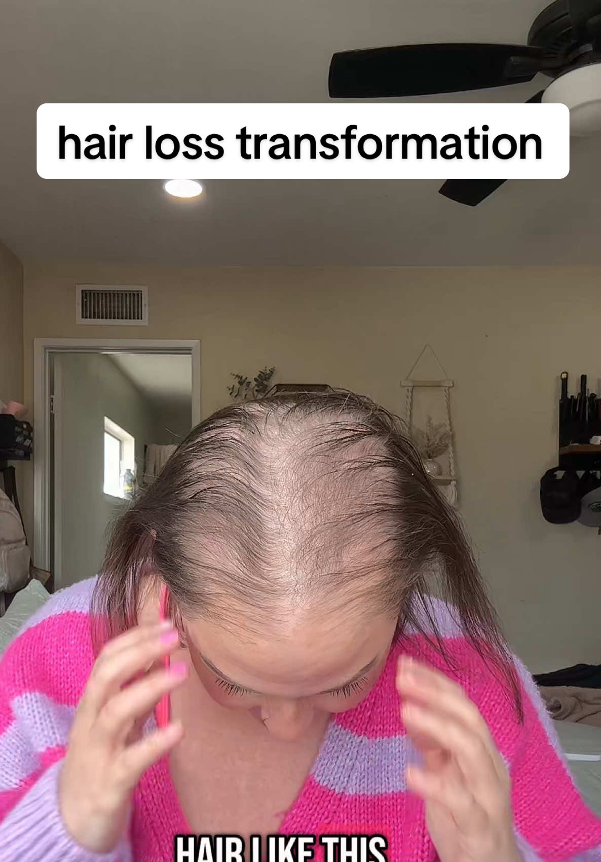 #hairlosstransformation #gluelesswigtutorial #androgenicalopecia #femalehairloss 