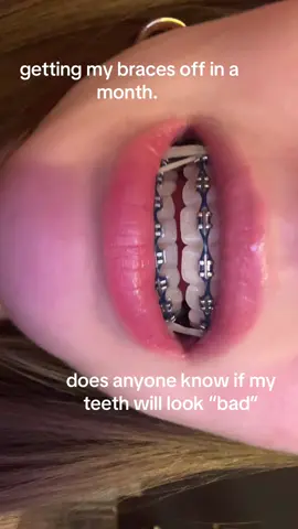 ignore how dumb i look #braces #fyp