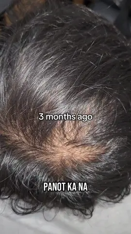 Panot or nakakalbo naba ang ulo mo? why not try #hosoku  #hosokubiotincollagen  #panot  #hairgrower 