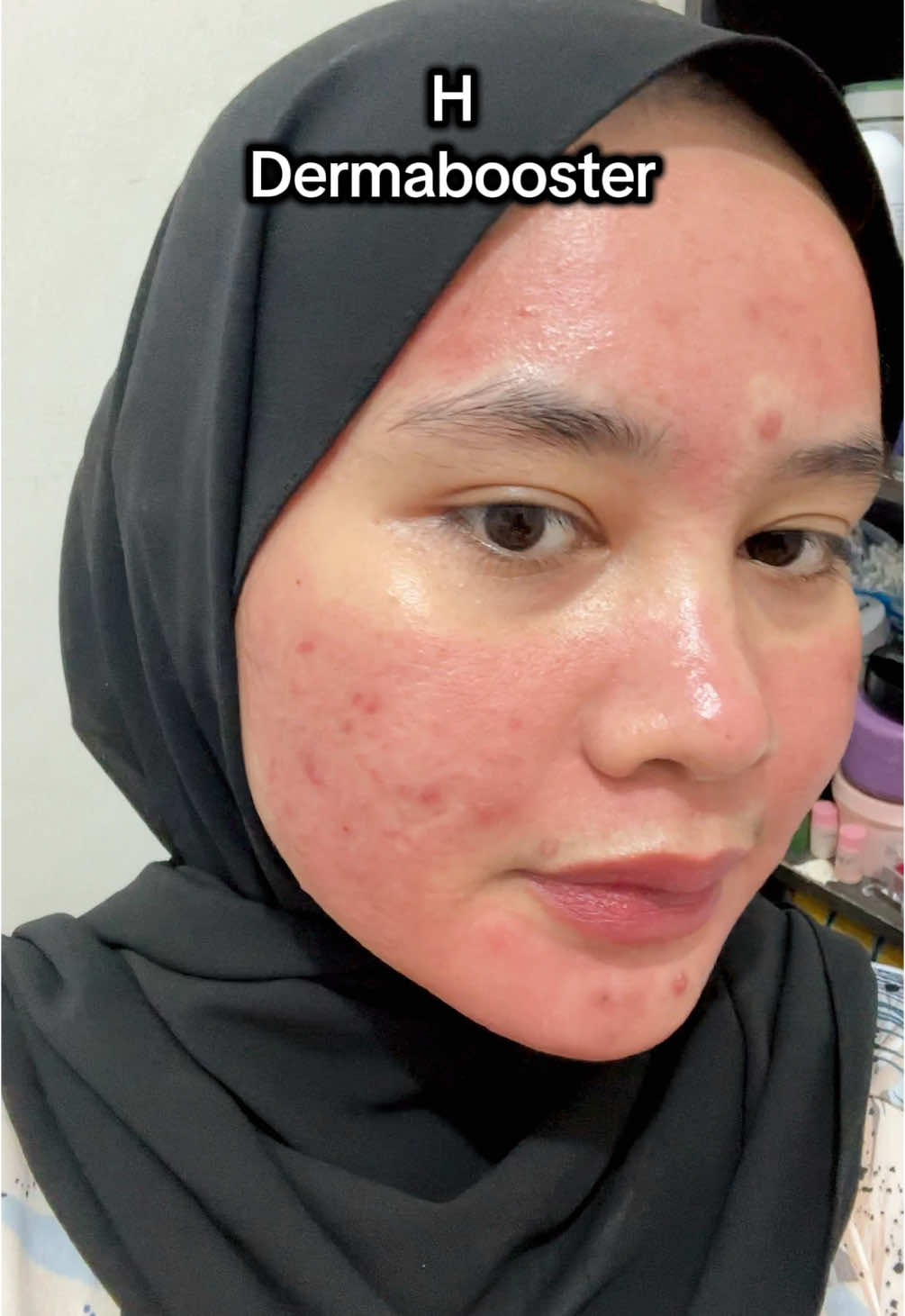 Belum maksimal karena baru 1x treatment, tapi udah ada perubahan dalam waktu seminggu #naavagreen #dermabooster 