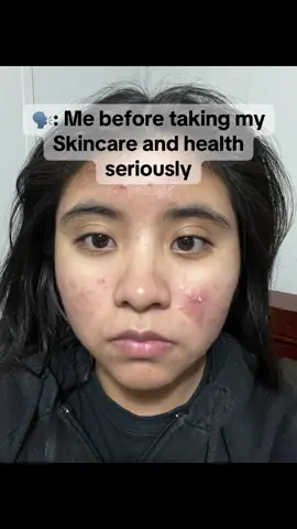 I was once told that skincare doesn’t help with acne and I had multiple people give me unsolicited advice even though I was already trying almost everything to clear my acne and sometimes I wanted to give up but I persevered and the consistency and research paid off and I am grateful to be where I am even if it’s not considered clear glass skin🙌🏼 #skincarejourney #acneskin #acnejourney #koreantiktok #koreanskincareproducts #clearskin #clearskintips 