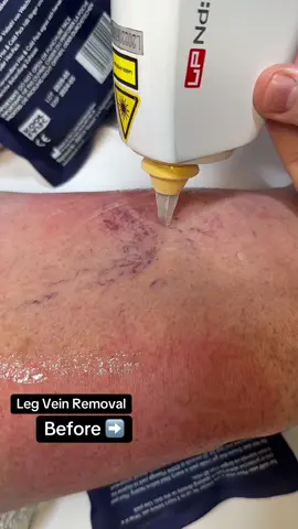 Singing whilst I laser these leg veins away! Long-pulsed Nd:YAG laser thread vein removal works by targeting the blood within the veins, causing it to coagulate and the vein to collapse, which the body then naturally absorbs!  #laser #legs #legveins #veins #lasertreatment #skin #legday 