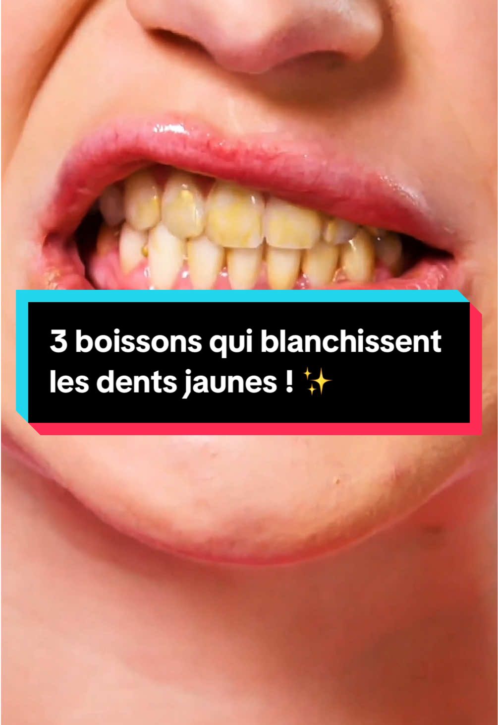Dents jaunes ? ⚠️ Voici 3 boissons naturelles qui les rendent plus blanches sans produits chimiques ! 😁🥤 1️⃣ Eau citronnée – Élimine les taches et redonne de l’éclat à l’émail. 2️⃣ Infusion de sauge – Nettoie, purifie et lutte contre la plaque dentaire. 3️⃣ Eau de coco – Combat les bactéries et rafraîchit l’haleine tout en blanchissant. Testez-les et faites briller votre sourire naturellement ! #dents #caries #blanchimentdentaire #conseilsanté #citron 