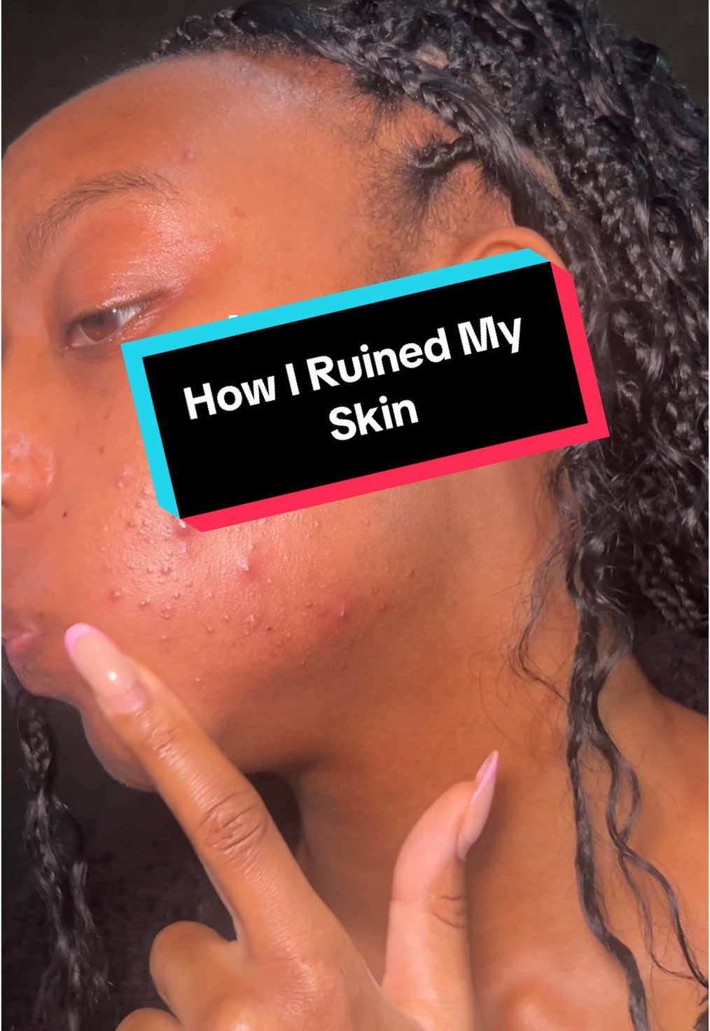 Have you ever felt like your skin was ruining your confidence? Tell me in the comments—I really want to hear your story. A few months ago, I didn’t recognise myself. As a skincare doctor, struggling with acne felt humiliating. I was breaking out badly, and it got to a point where I didn’t want to show up online at all. But I kept going. I stuck to a routine, gave my skin what it needed, and most importantly—gave myself grace. Two months later, I finally feel like myself again. If you’re struggling with your skin right now, I promise it doesn’t define you. It gets better. You’re still worthy, still beautiful, and still you. #skintok #glowinskin #acne #acnefighter #skintransformation 