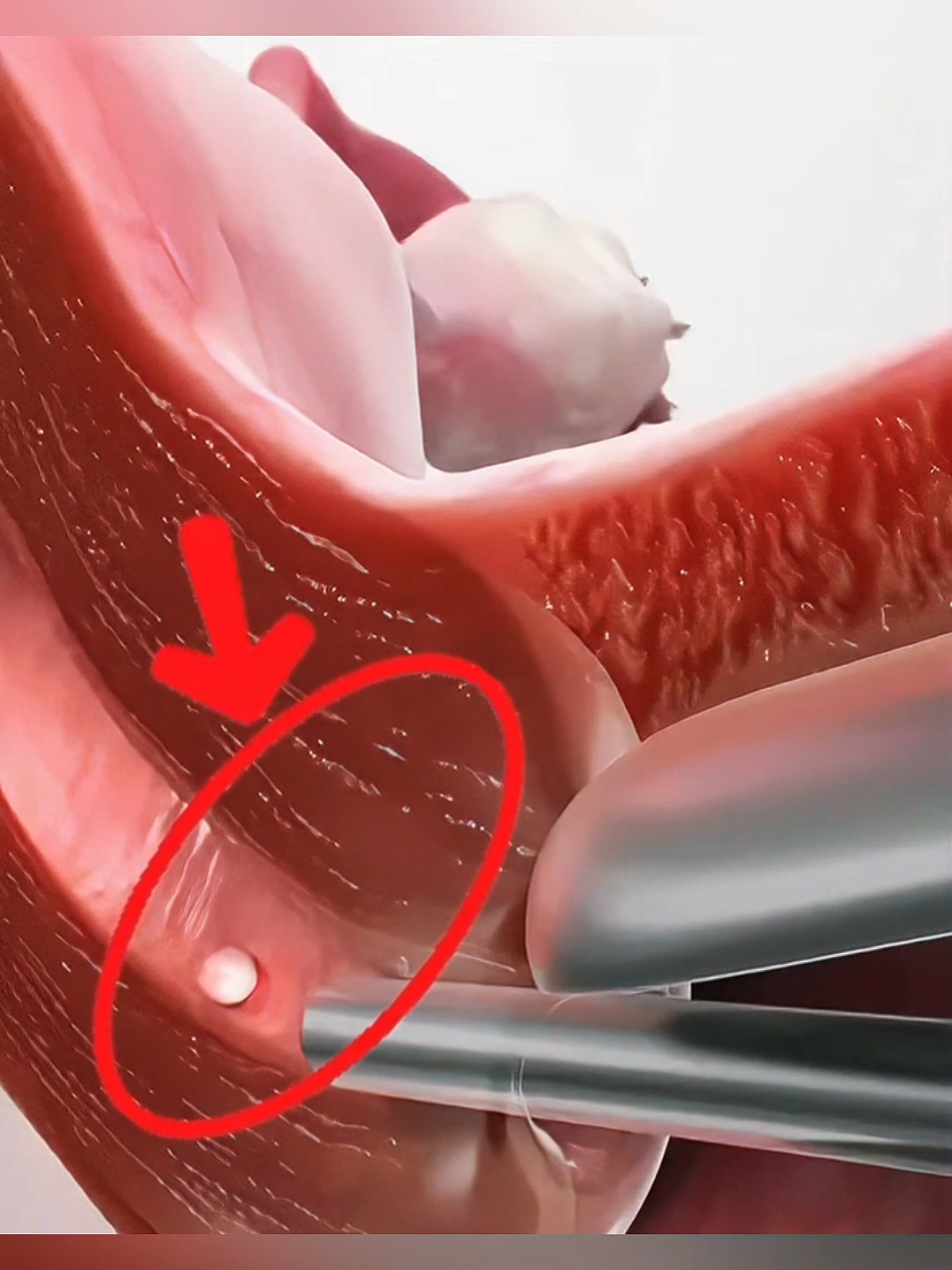 sintamos de câncer no útero  #cancernoutero #saude #utero #cancerdeutero #cancer #Utero   #cancernocolodoutero #saude  #saudedamulher 