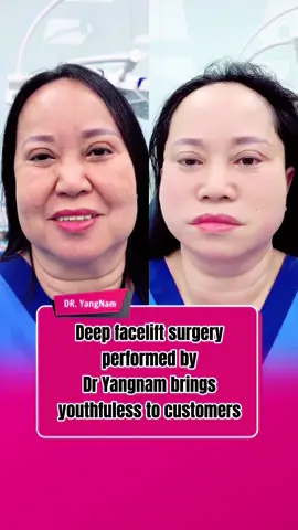 Deep facelift surgery performed by Dr YangNam brings youthfuless to customers #facelift #opfacelift #comesticsurgery #operasi #surgery #dryangnam #indonesia #tiktokindonesia #tiktokviral #fybシ 