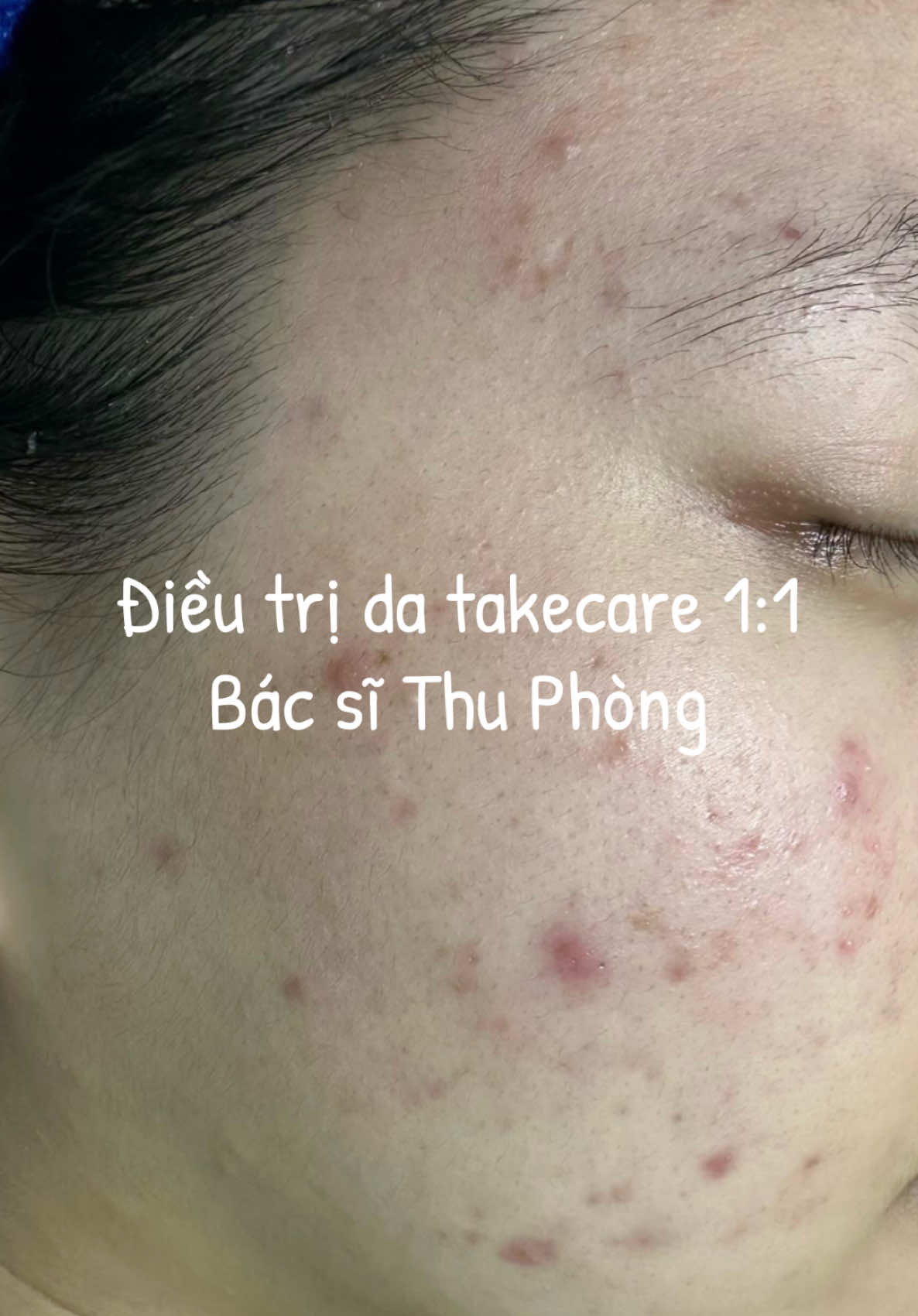 Capcut 1 tẹo thôi#bsthuphong #LearnOnTikTok #bacsidalieu #trimun 