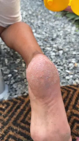 Put honey on your feet and the next day you won't believe the results! #lifehacks #homehacks #tips