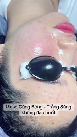 Meso Căng Bóng- Trắng Sáng cho khách nhà em💉💉 #mesotherapy #spa #cangbong 