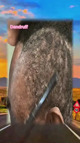 #dandruff #dandruffscratching #dandruffremoval #dandruffremovel #asmrvideo #fypage #satisfyingvideos #psoriasis #capcutedit #capcut