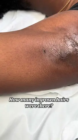 Wait for the surprise 😳🤭. #ingrownhair #trappedhair #manchesterwaxer #extraction #ingrownhairremoval 