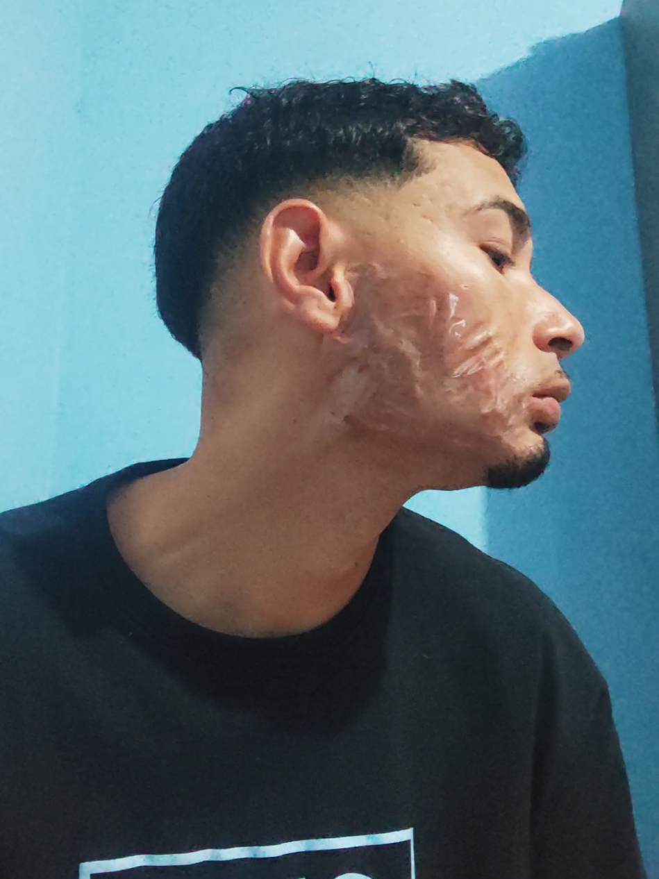A responder a @desativado18551 eu usava drenison, agora eu coloco uma fita mesmo é mais rápido e não custa nada 🤣 #roacutan #esteticafacial #cicatrices #explore #espinhas #acne #fpyシ #cicatriz #fitadesiliconeposcirurgica 