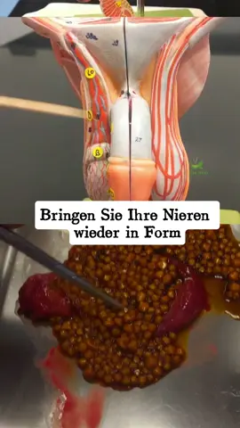 #gesundheit #kidneystone #kidneyfailure #Niere #gesund #nierensteine #kidney #nebenniere 