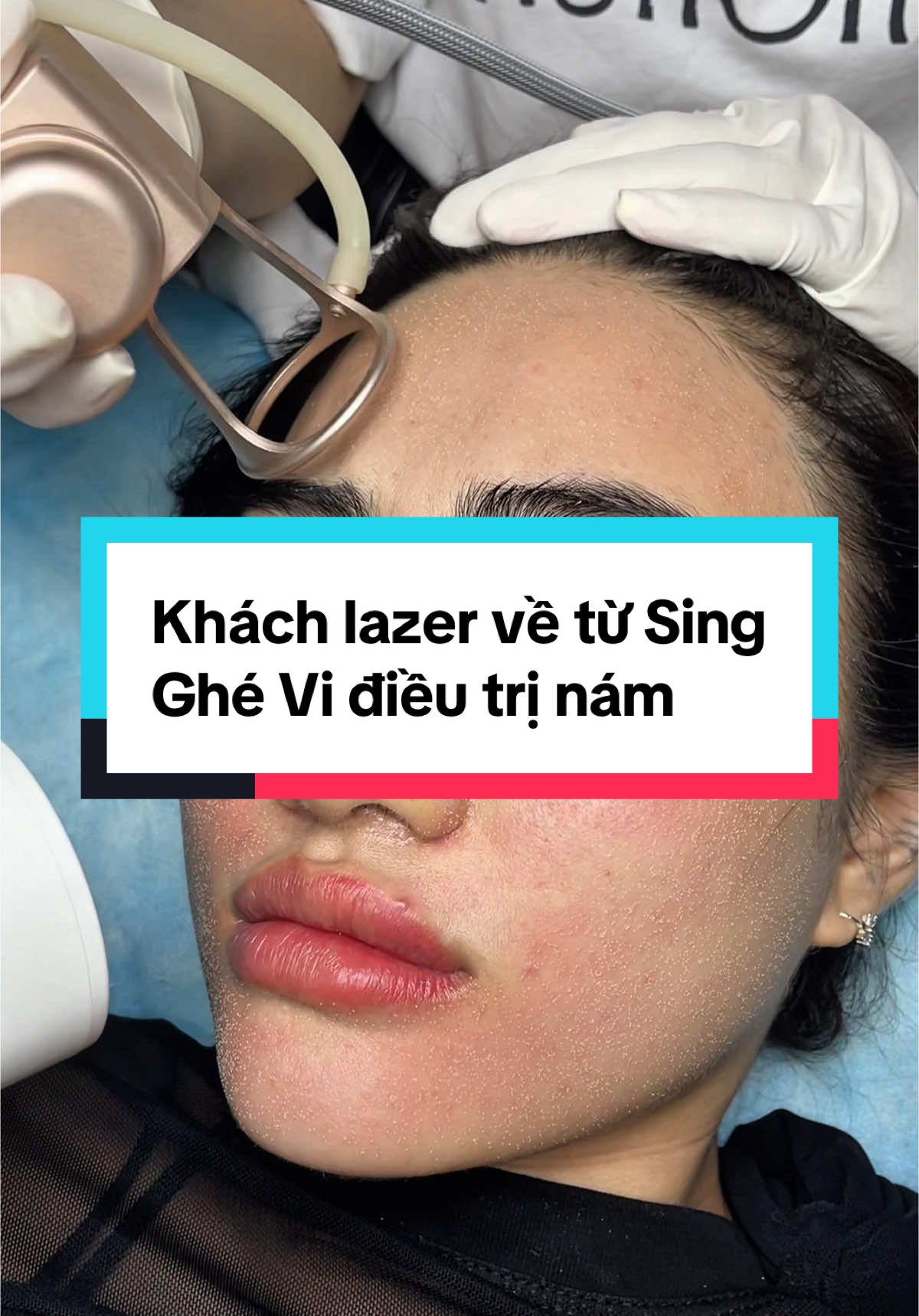 Có duyên với khách sing ạ#ViVi_Spa #điều_trị_mụn_nám_tàn_nhang_đồi_mồi #Nám_mảng #Nám_chân_sâu #Tàn_Nhang #Bớt_hori #Bớt_hori #xuhuong #xuhuong2023 