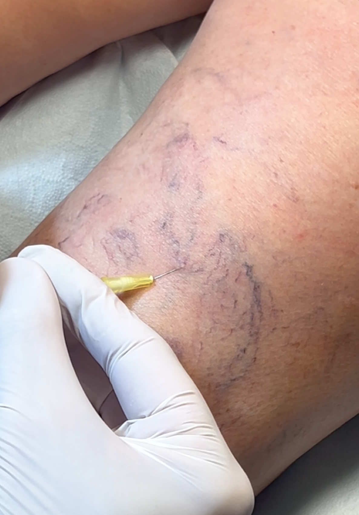 ✅ Scleroterapia  #sclerotherapy #venevaricose 