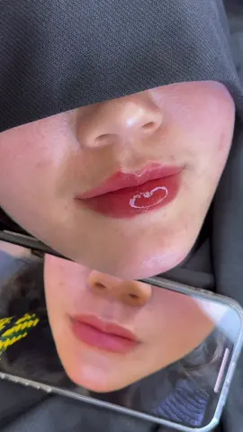 Kỹ thuật Dlowslips Ver2. Tiêm môi 4.0 - Không sưng,không đau,không bầm tím và không tốn Filler.  Môi tiêm 10 ổn định còn 9,5 luôn ạ. Kỹ thuật mới nhất mà Tera tâm huyết nhất kỹ thuật 2025! #tranhueanhfiller #dlowslipsver2 #khoahocfillerbotox #teragroud #khoahocfillerbotox  #tiemtranbaby  #tiemmoi 