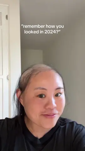 Did you know? Excessive hair loss can lead to permanent baldness if not treated promptly. Contact us now for advice! #PreventHairLoss #HairGrowthSerum #FastHairGrowth #ReduceHairLoss #hairconfidence #thickerhair #hairgrowthsecrets #hair #hairloss #baldness