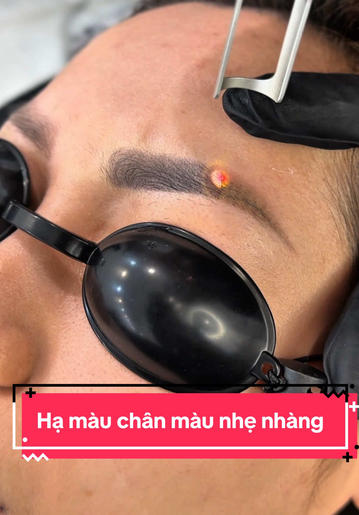 Xoá xăm chân mày buổi đầu tiên nhà Tami . Nhẹ nhàng và êm ru #xoaxam  #xoaxamlaser #xoaxamlongmay  #xoalongmaylazercaocap 