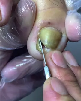 Pedicure #fypシ #fyp #foryou #ingrowntoenail #doctorming #pedicure 