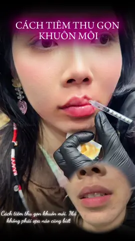 Kĩ thuật tiêm thu gọn khuôn môi ko ai ai cũng sẽ nói cho bạn biết