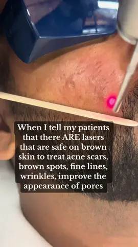 There ARE lasers that are safe on darker skin for treatment of scars, brown spots, wrinkles/fine lines! As a dermatologist who specializes in patients with dark skin- this is something I do every single day! Please look for the right doctor who is comfortable treating patients with diverse skin tones!  #laser #acnescars #acnescartreatment #hyperpigmentation #brownspots 