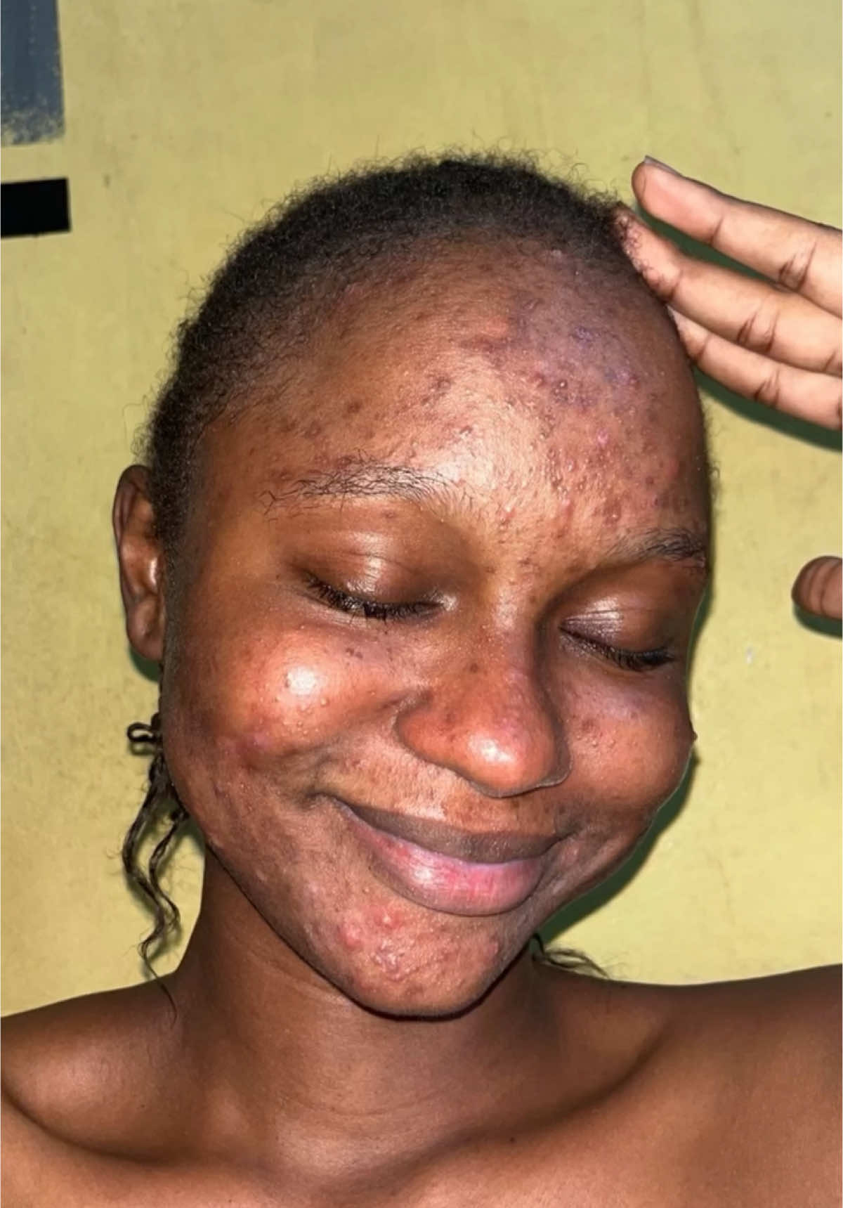 Vous souffrez d’acné ou de boutons qui ne finissent point sur visage alors voyez de vous même le résultat et ce témoignage de @🌙📿 فاطِمَة بَارِيّ 🧕🤍 🕌🌙  Nos kit corps est 100% naturels et efficaces pour vos acnés alors vous attendez quoi pour commander ? ☎️ +225 0141439090 #palmita #huiledepalmiste #fyp #abidjan225🇨🇮 #temoignage 