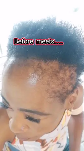 Lemonade braids hairstyle.  #lemonadebraids #braidstyles #feedincornrows #alopeciahairstyles #nohairlinehairstyle #straightback #straightup #southafricatiktok #explorepage #hairtransformation #newlook #tutorial #sama28 #southafrica 