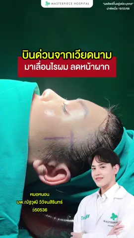 สวยหวานอยู่แล้วแต่อยากเป๊ะขึ้นอีก จึงเลือกมาปรับสัดส่วนใบหน้าให้สมส่วนมากขึ้น ด้วยการเลื่อนไรผม ลดขนาดหน้าผาก  เคสนี้ลดลงไปได้ถึง 2 เซ็นติเมตร  บอกเลย…หลังทำละมุนมากกกกก นี่แหละ…ความสวยที่ตามหา✨ #หมอหนอน #เลื่อนไรผม #เลื่อนไรผมลดขนาดหน้าผาก #มาสเตอร์พีช #โรงพยาบาลมาสเตอร์พีช #Masterpiece #Masterpiecehospital  #lldowmaster #ceomasterpiece #พี่ดาวมาสเตอร์พีช 