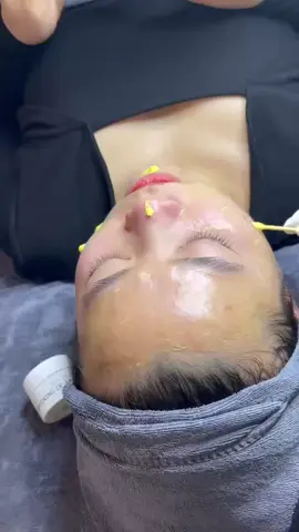 Làm đẹp mà thiếu khoản Peel A này thì thực sự tiếc cho làn da lắm ạ 🥰 #peelcangbongtrehoa  #peelmun  #peelmunkhongbong  #chamsocdakhoahocbangduocmypham  #MinhHangSpa  #xuhuongtiktok 