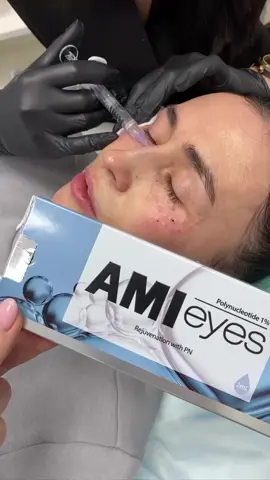 Ami Eyes tiêm meso quanh vùng mắt cải thiện cực tốt ❤️❤️ #amieyes #ami #trend #xuhuong 