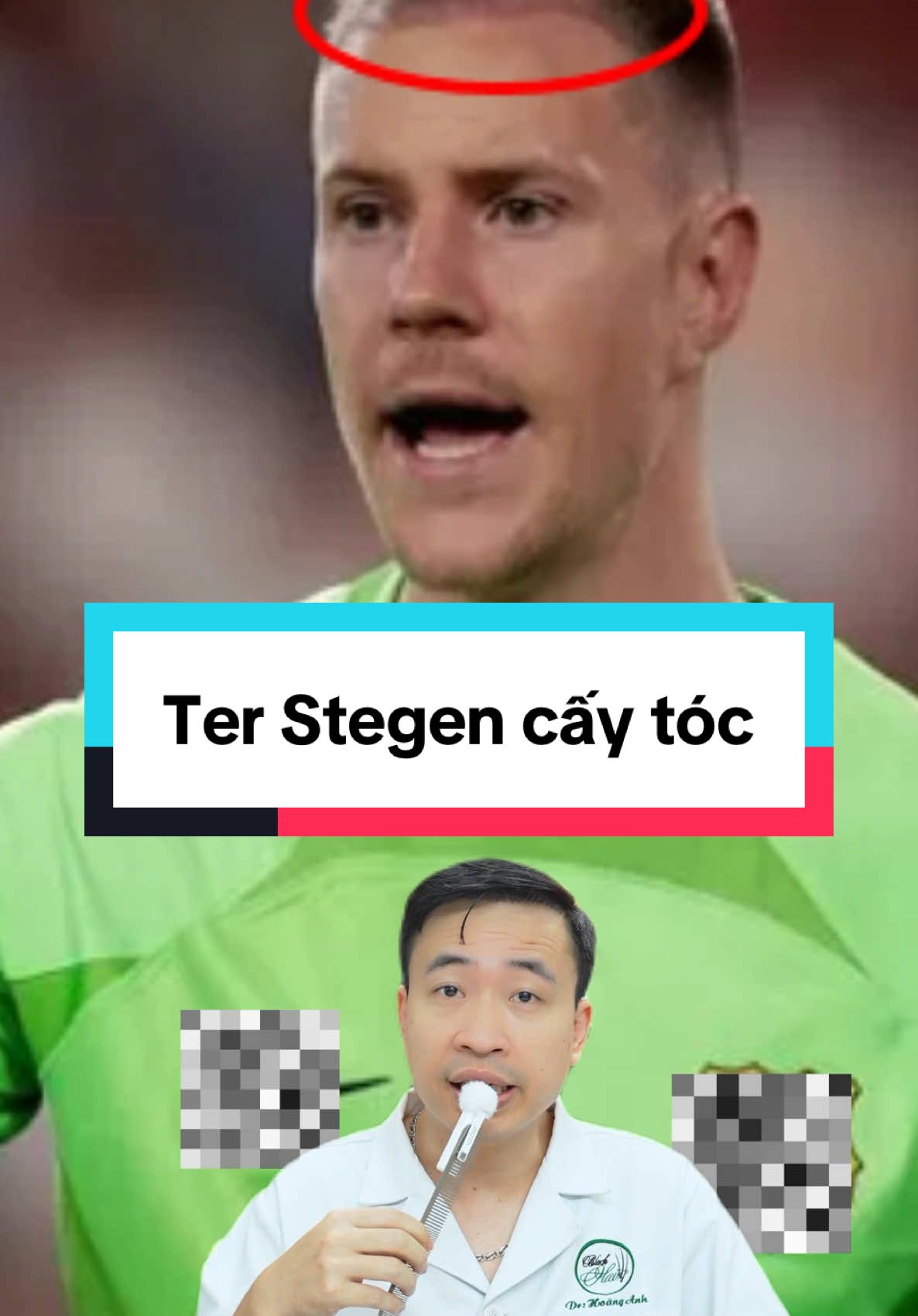 Cập nhật tình hình cấy tóc của Ter Stegen. Các bạn thấy kết quả cấy tóc như thế nào? #xuhuong #drhoanganhcaytoc #bacsihoanganh #caytoc #terstegen 