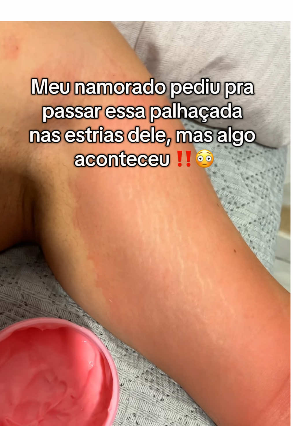 Gente 😳 #estrias #estriasbrancas #pov 