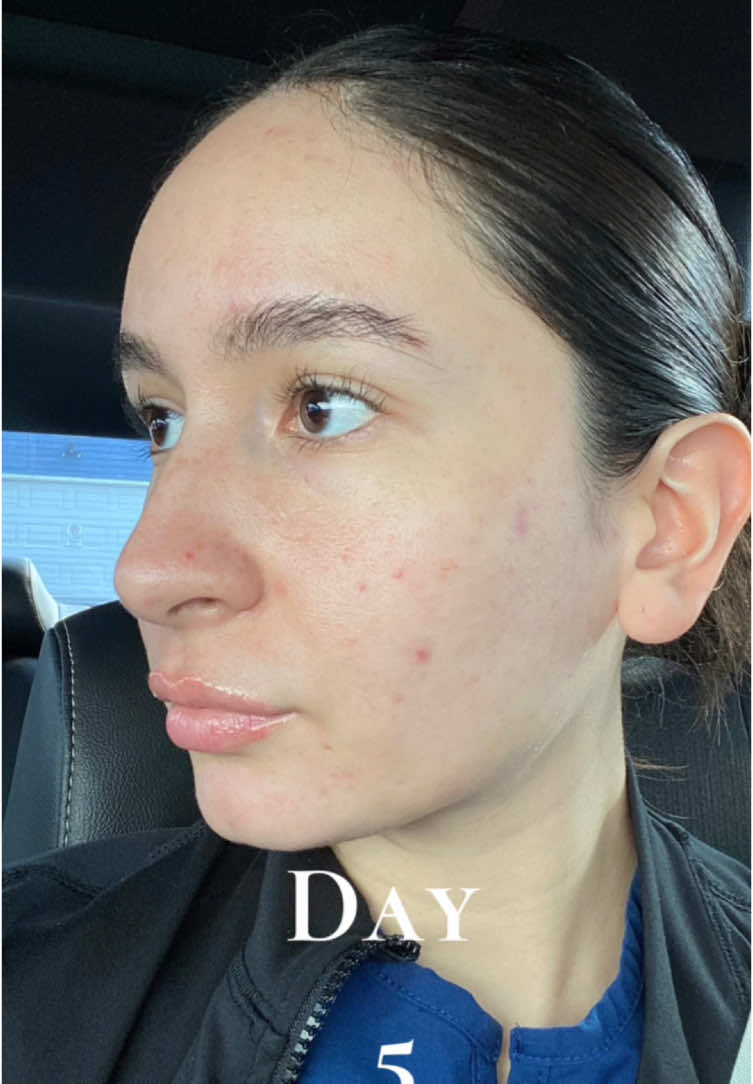What does microneedling do? stimulates the body's natural healing process to produce more collagen and elastin, leading to improved skin texture and appearance using tiny needles. 💫#microneedling #facialtreatment #skin #fypシ 