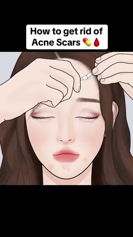 How to get rid of Acne Scars #skincare #skincareroutine #skincaretips #tips #makeup #scars #acne 