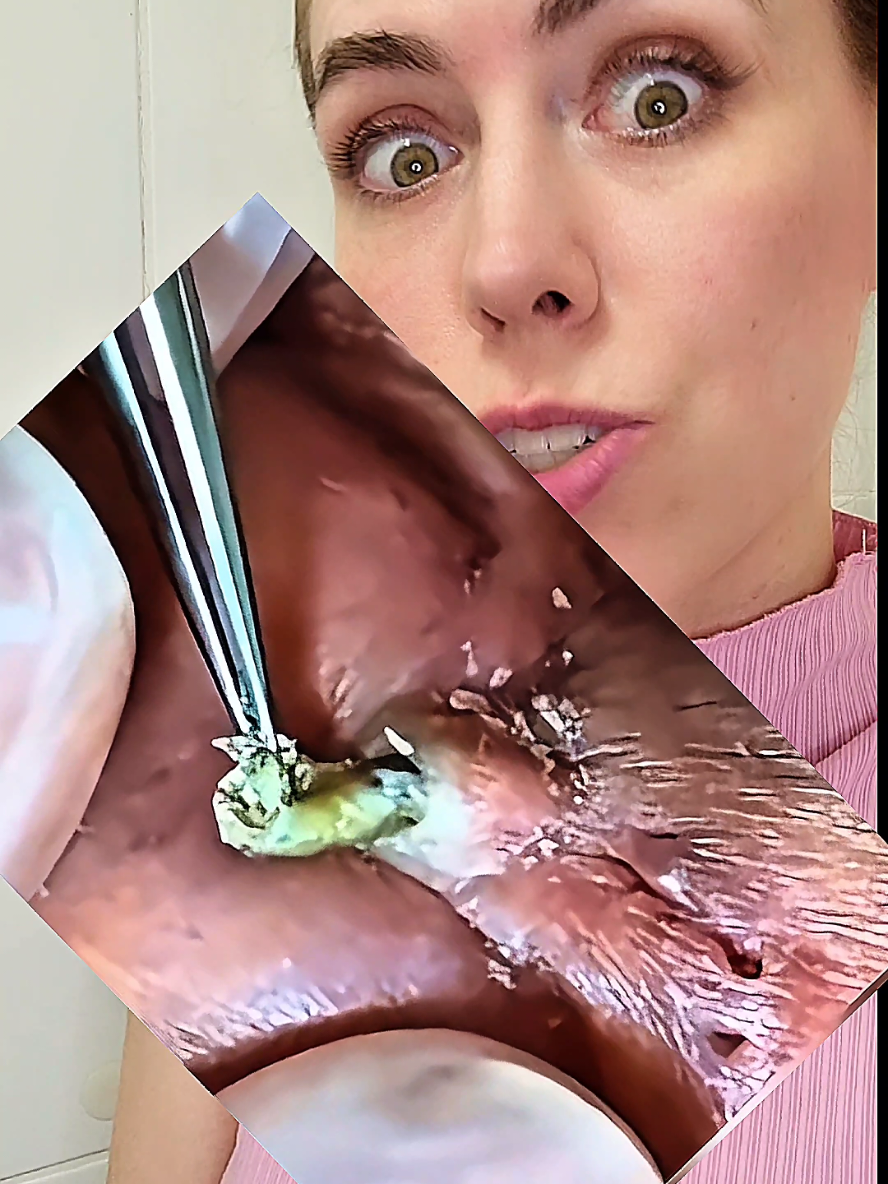 Vídeo de extração de milhões! #cravos #limpezadepele #skincare #extractions #videoviral 