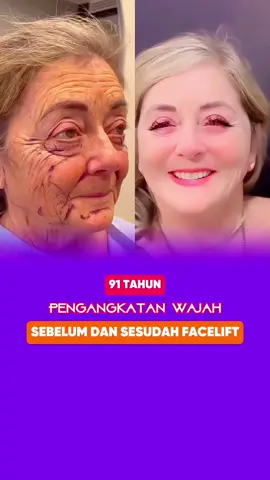 Apakah menurut Anda wanita berusia 91 tahun itu terlihat lebih muda setelah operasi pengencangan wajah?#facelift #jakarta #indonesia #trending #viral #drryo #surgery #videoviral #rhinoplasty #virral 